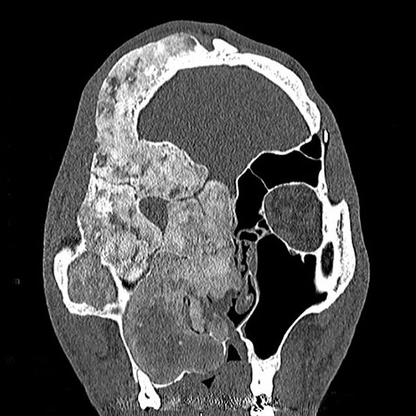 File:Craniofacial fibrous dysplasia (Radiopaedia 9631).jpg