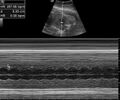 Fetal tachycardia (Radiopaedia 29546).jpg