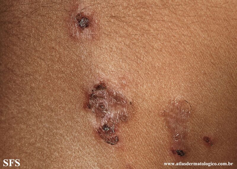 File:Impetigo (Dermatology Atlas 84).jpg