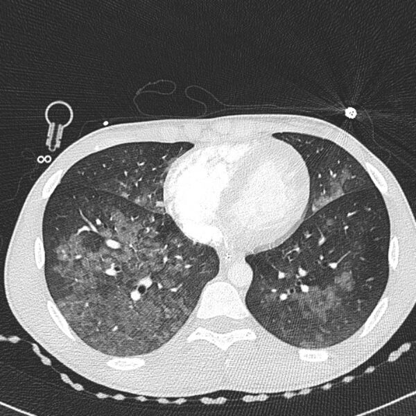 File:Near drowning (pulmonary edema) (Radiopaedia 24685-24958 lung window 54).jpg