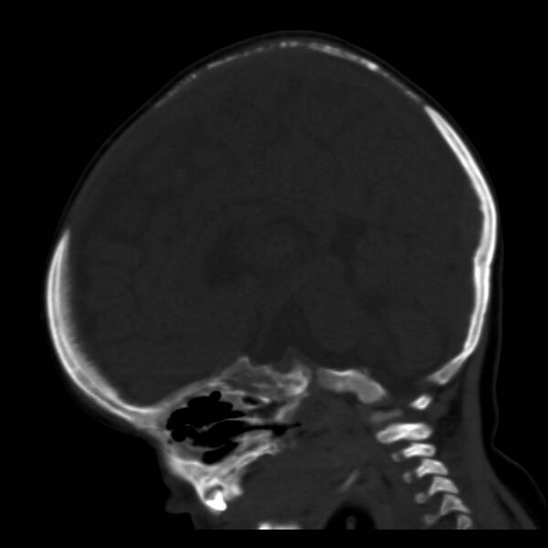 File:Neuroblastoma with skull metastases (Radiopaedia 30326-30958 Sagittal bone window 23).jpg
