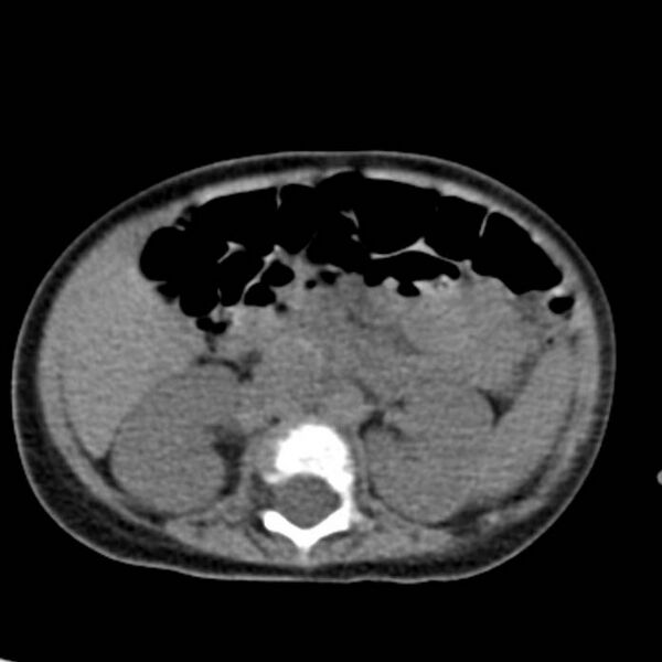 File:Neuroblastoma with skull metastases (Radiopaedia 30326-30960 Axial non-contrast 28).jpg