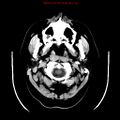 Neuroglial cyst (Radiopaedia 10713-11185 Axial non-contrast 31).jpg