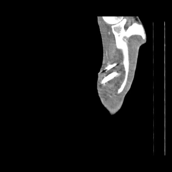 File:Non hodgkin lymphoma of the mediastinum (Radiopaedia 20814-20729 D 1).jpg