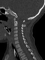 Normal CT cervical spine - pediatric (Radiopaedia 52549-58462 Sagittal bone window 85).jpg