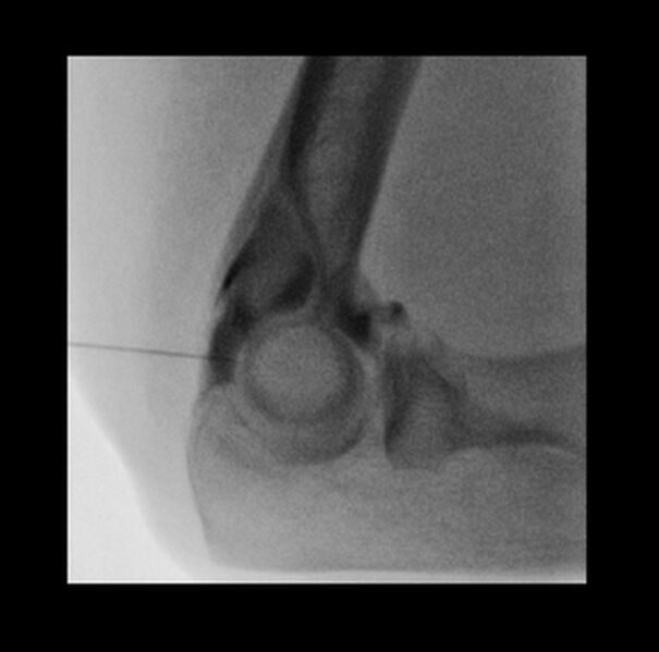 File:Normal elbow arthrograms (Radiopaedia 75550-86830 B 1).jpg