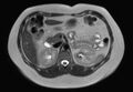 Normal liver MRI with Gadolinium (Radiopaedia 58913-66163 Axial T2 16).jpg
