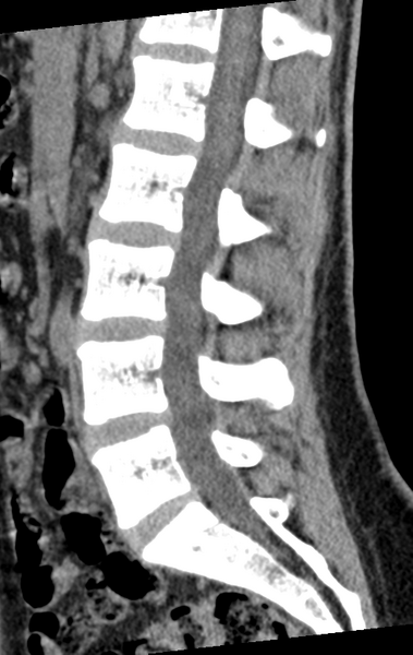 File:Normal lumbar spine CT (Radiopaedia 46533-50986 C 50).png