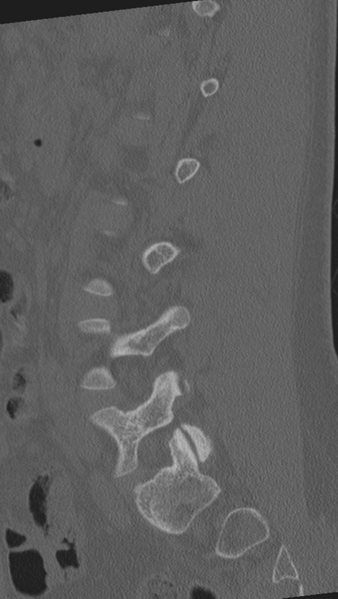 File:Normal lumbar spine CT (Radiopaedia 46533-50986 Sagittal bone window 36).png