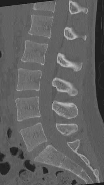File:Normal lumbar spine CT (Radiopaedia 46533-50986 Sagittal bone window 51).png
