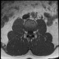 Normal lumbar spine MRI (Radiopaedia 35543-37039 Axial T1 27).png