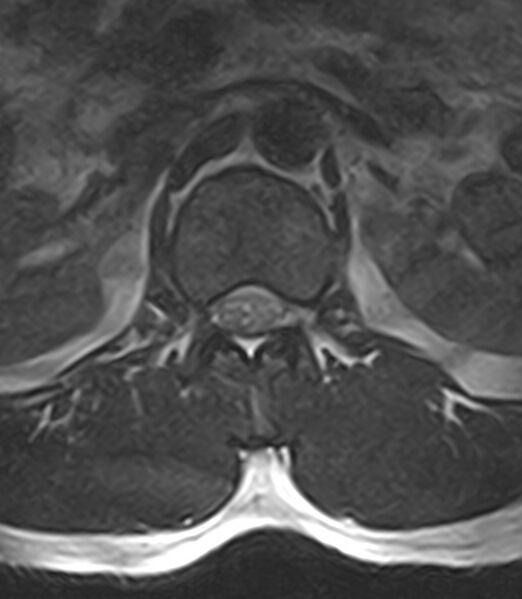 File:Normal lumbar spine MRI - low-field MRI scanner (Radiopaedia 40976-43699 Axial T2 21).jpg