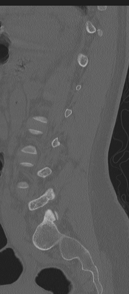 File:Normal lumbosacral CT (Radiopaedia 37923-39867 Sagittal bone window 33).png