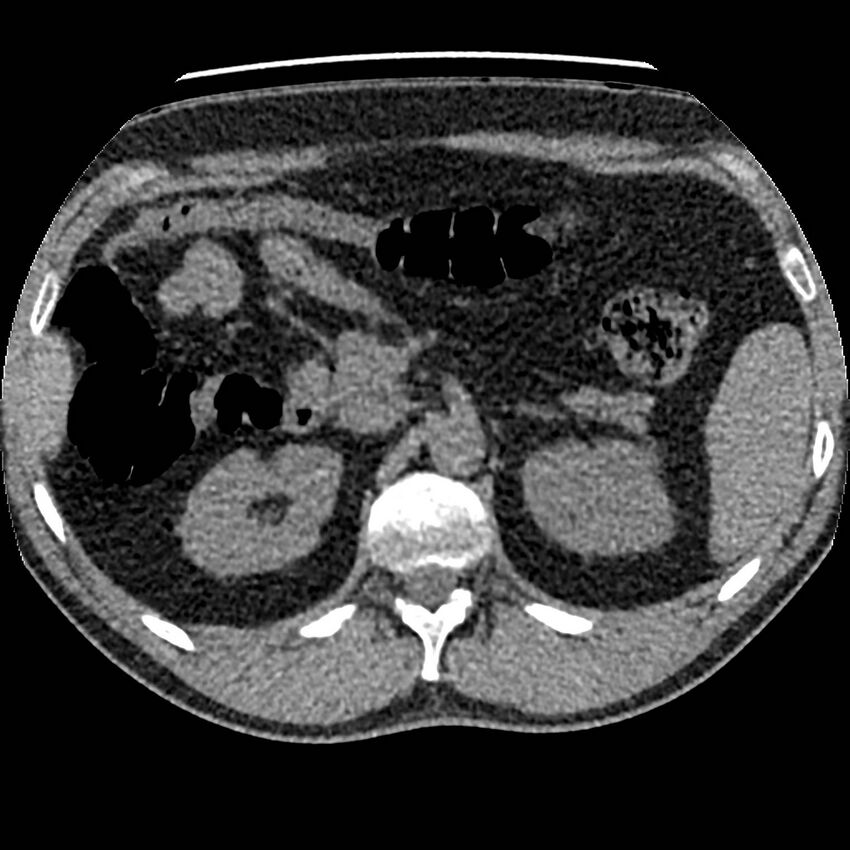 Obstructing ureteric calculus and ureteric anatomy (Radiopaedia 62730-71042 Axial non-contrast 22).jpg