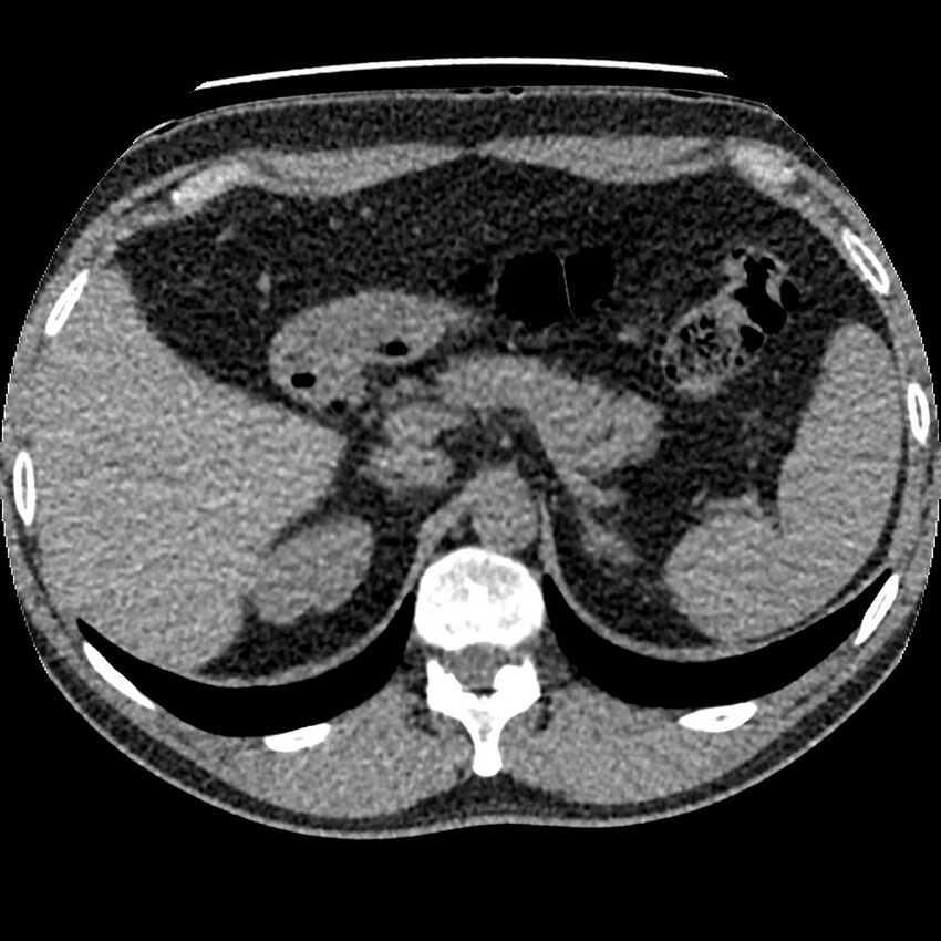 Obstructing ureteric calculus and ureteric anatomy (Radiopaedia 62730-71042 Axial non-contrast 8).jpg