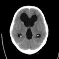Obstructive hydrocephalus (Radiopaedia 30453-31119 Axial non-contrast 12).jpg