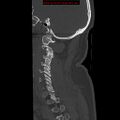 Occipital condyle fracture (Radiopaedia 18366-18208 Sagittal bone window 8).jpg
