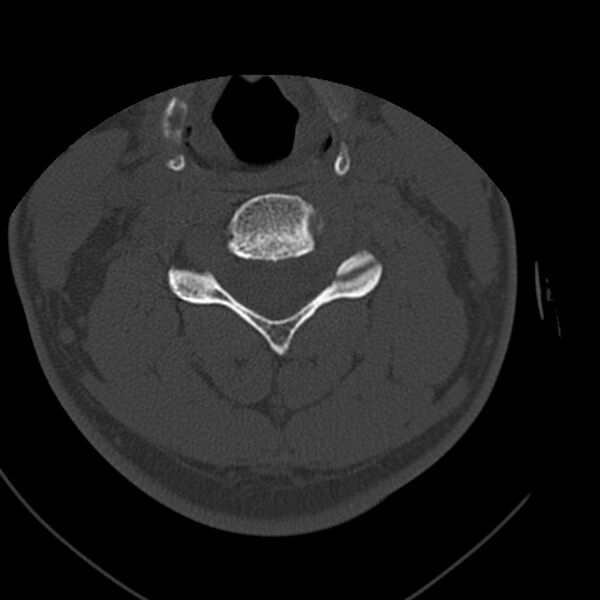 File:Occipital condyle fracture (Radiopaedia 31755-32691 Axial bone window 42).jpg