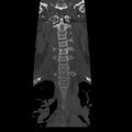 Occipital condyle fracture (Radiopaedia 31755-32691 Coronal bone window 9).jpg