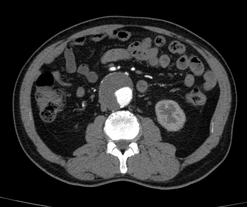 Abdominal aortic aneurysm (Radiopaedia 22421-22458 C+ arterial phase 43).jpg
