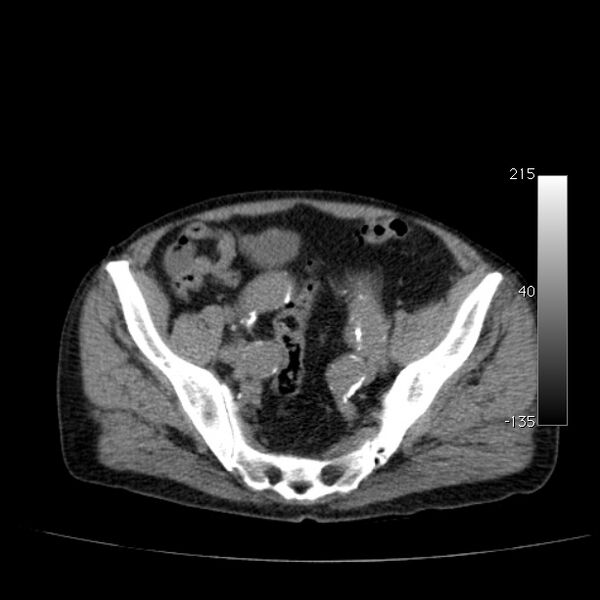 File:Abdominal aortic aneurysm (Radiopaedia 29248-29660 Axial non-contrast 46).jpg