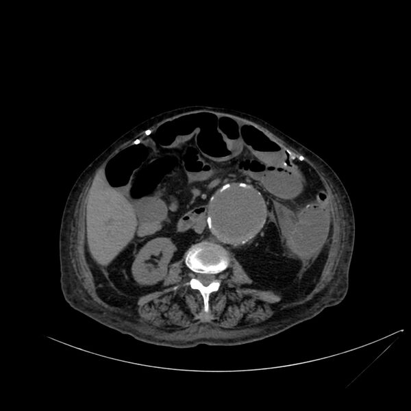 File:Abdominal aortic aneurysm - impending rupture (Radiopaedia 19233-19246 Axial non-contrast 65).jpg