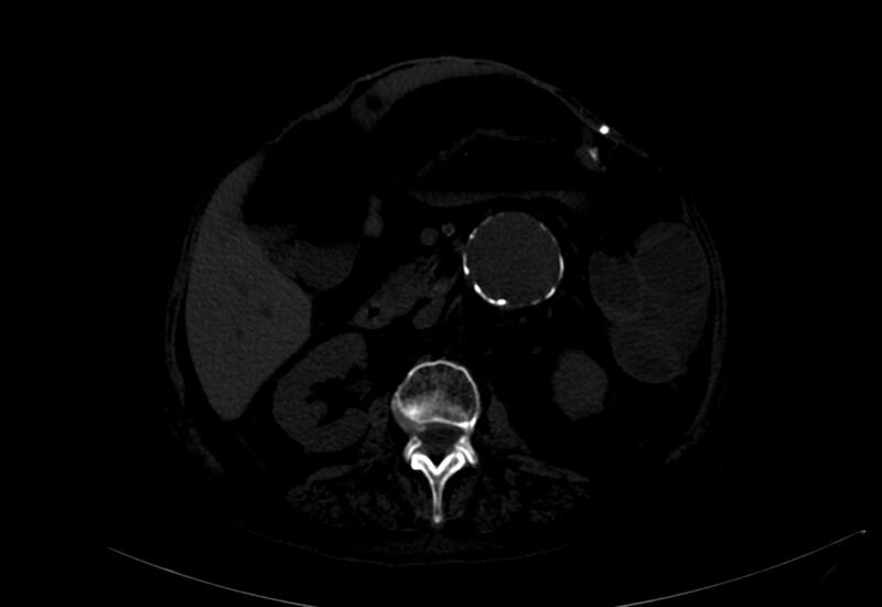 File:Abdominal aortic aneurysm - impending rupture (Radiopaedia 19233-19246 B 8).jpg