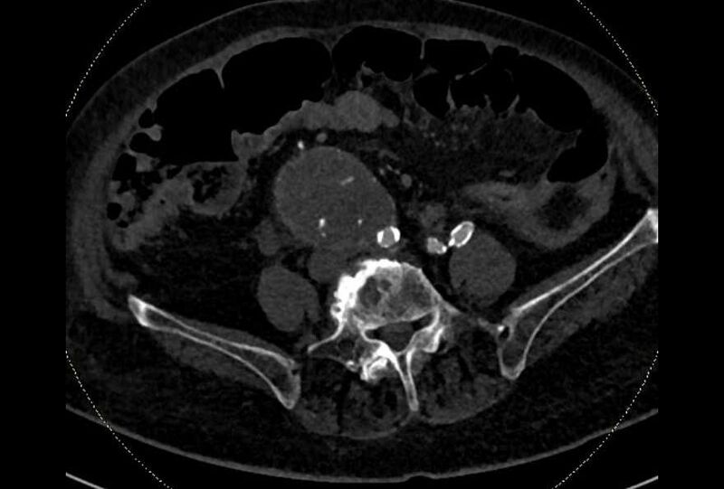 File:Abdominal aortic aneurysm with thrombus fissuration (Radiopaedia 73192-83919 Axial C+ arterial phase 143).jpg