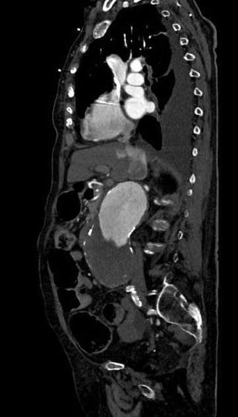File:Abdominal aortic aneurysm with thrombus fissuration (Radiopaedia 73192-83919 Sagittal C+ arterial phase 84).jpg