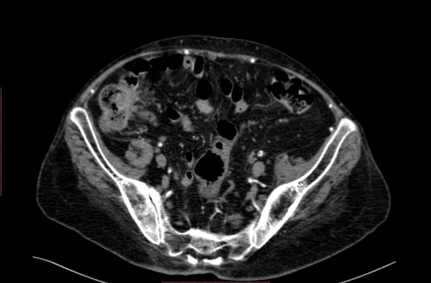 Abdominal aortic interposition tube graft and aneurysm thrombosis (Radiopaedia 71438-81857 Axial C+ arterial phase 175).jpg