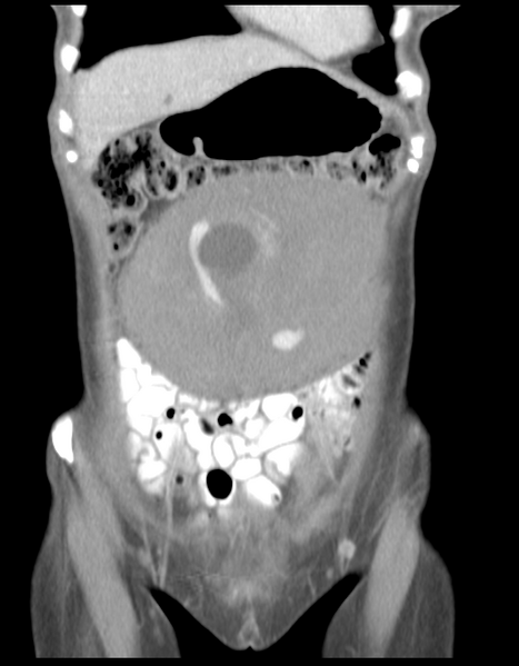File:Abdominal desmoid tumor (Radiopaedia 41007-43740 Coronal C+ portal venous phase 10).png