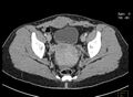 Abdominal wall endometriosis post C-section (Radiopaedia 20338-20251 Axial C+ portal venous phase 1).jpg