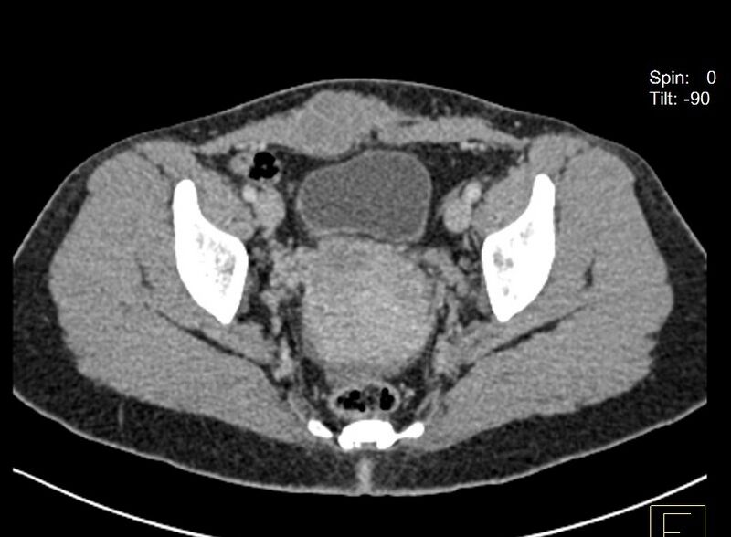 File:Abdominal wall endometriosis post C-section (Radiopaedia 20338-20251 Axial C+ portal venous phase 1).jpg