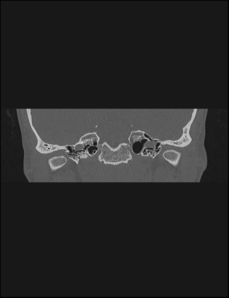 File:Aberrant right internal carotid artery (Radiopaedia 65191-74198 Coronal non-contrast 31).jpg