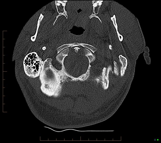 File:Accessory articulation of cervical transverse processes (Radiopaedia 82715-96933 Axial non-contrast 9).jpg