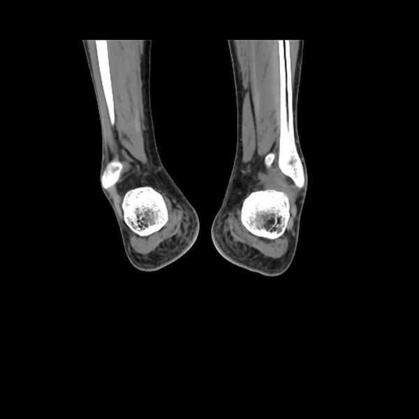 File:Accessory soleus muscle (Radiopaedia 61069-68943 Coronal non-contrast 57).jpg