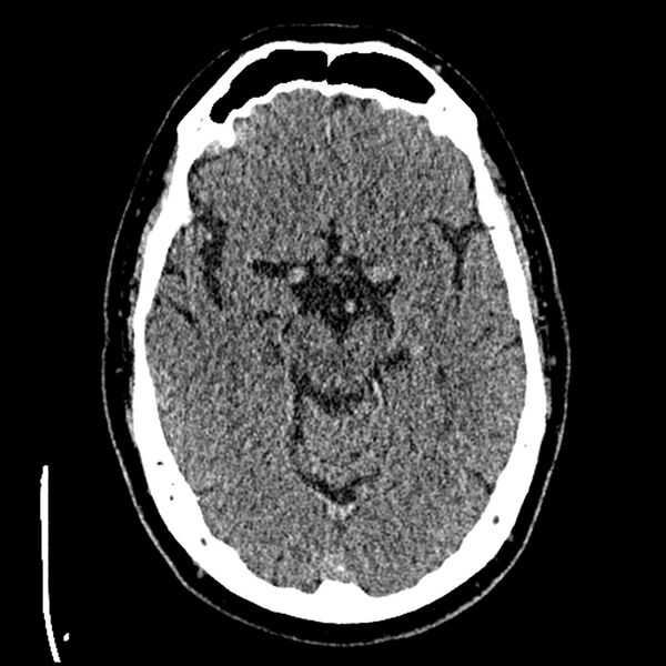 File:Acute A3 occlusion with ACA ischemic penumbra (CT perfusion) (Radiopaedia 72036-82525 Axial non-contrast thins 9).jpg