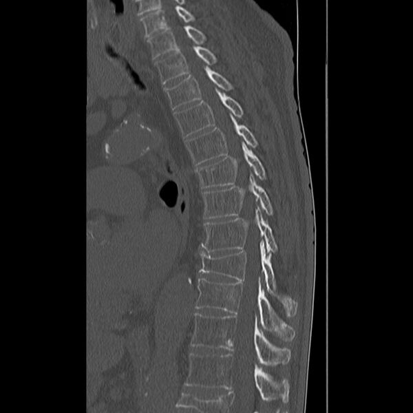 File:Acute and chronic vertebral compression fractures (Radiopaedia 31608-32494 Sagittal bone window 17).jpg