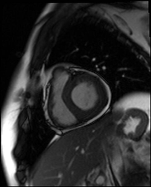 File:Acute anteroseptal myocardial infarction (Radiopaedia 68409-77944 Short axis (basal) SSFP cine 6).jpg
