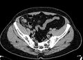 Acute appendicitis (Radiopaedia 13030-13091 Axial non-contrast 63).jpg