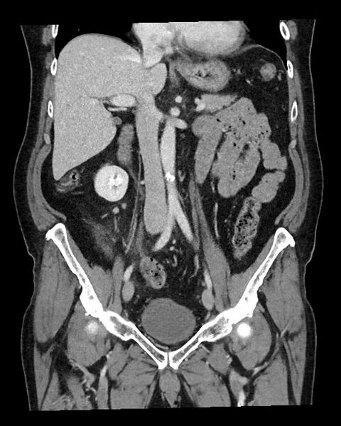 File:Acute appendicitis - large appendicoliths (Radiopaedia 61805-69820 Coronal C+ portal venous phase 66).jpg
