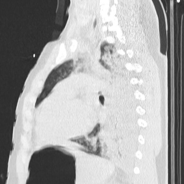 File:Acute aspiration pneumonitis (Radiopaedia 33605-34703 Sagittal lung window 54).jpg