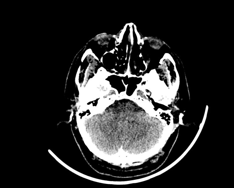 File:Acute cerebral infarct (Radiopaedia 35604-37123 Axial non-contrast 20).jpg
