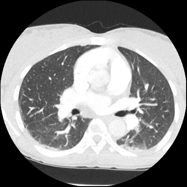 File:Acute chest syndrome - sickle cell disease (Radiopaedia 42375-45499 Axial lung window 90).jpg