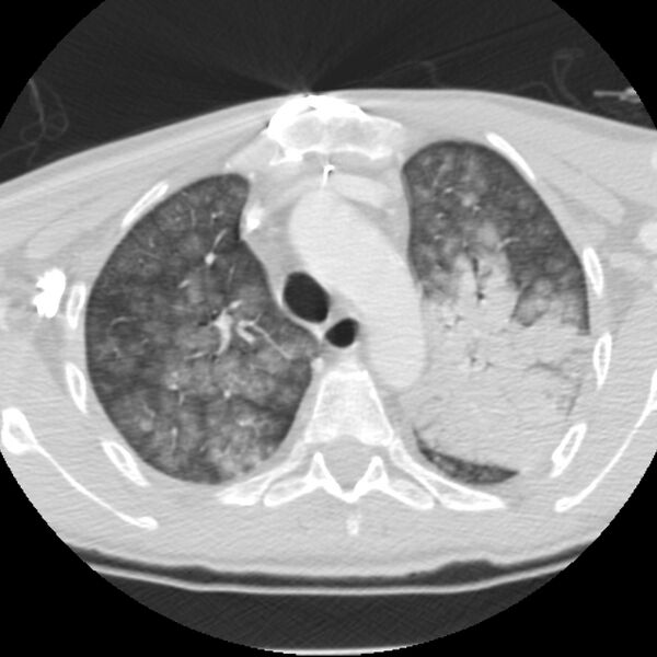 File:Acute diffuse alveolar hemorrhage (Radiopaedia 41323-44158 Axial lung window 14).jpg