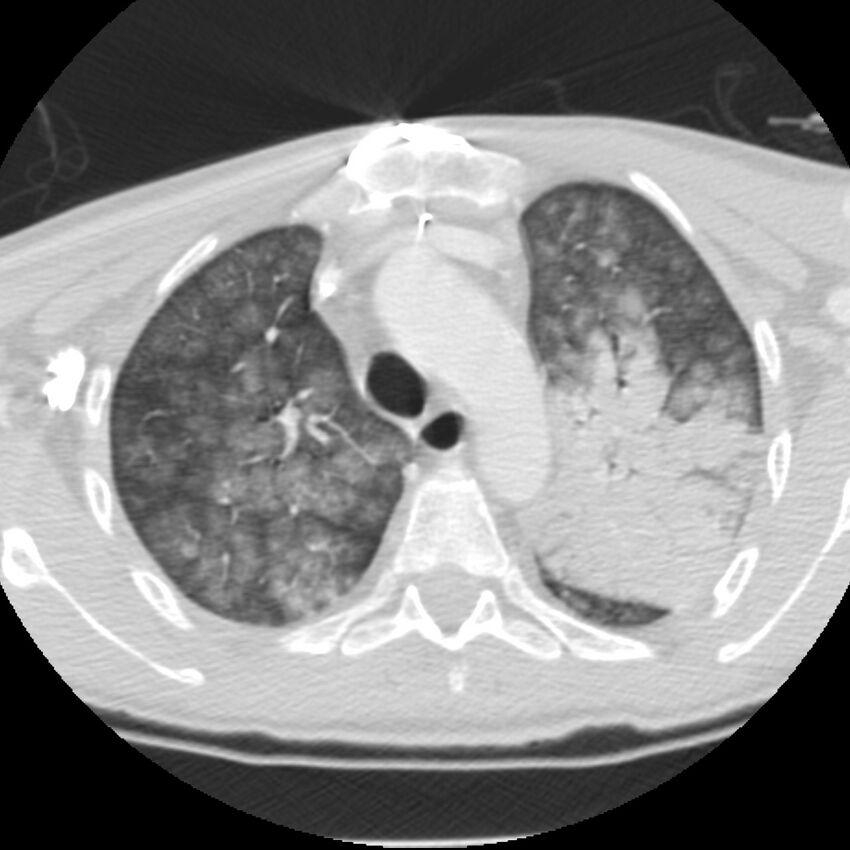 Acute diffuse alveolar hemorrhage (Radiopaedia 41323-44158 Axial lung window 14).jpg