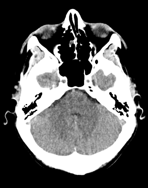 File:Acute disseminated encephalomyelitis (ADEM) (Radiopaedia 65319-74348 Axial non-contrast 9).png
