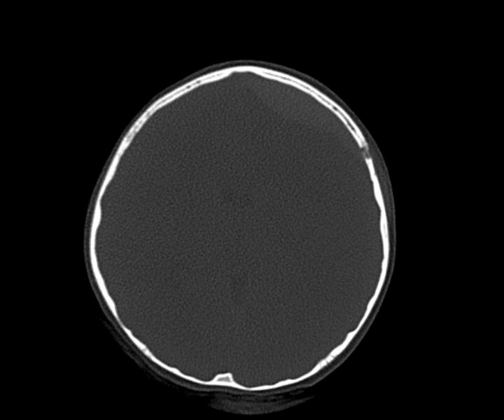 File:Acute epidural hematoma (Radiopaedia 63659-72335 Axial bone window 18).jpg