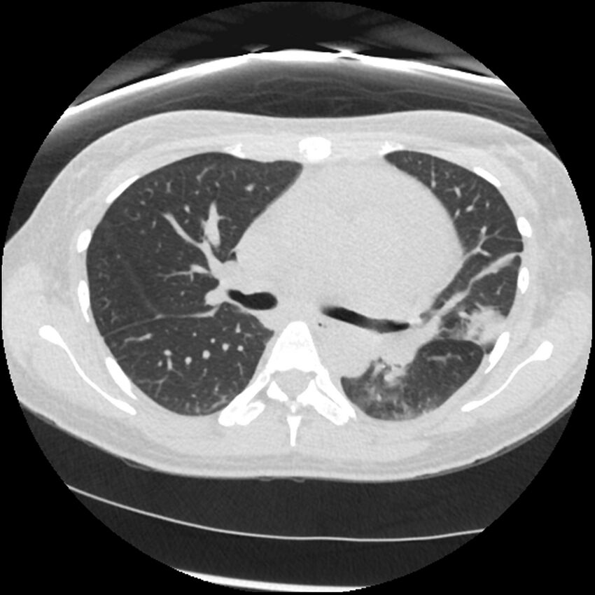 Acute lupus nephritis (Radiopaedia 45832-50107 Axial lung window 37).jpg