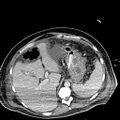 Acute pancreatic necrosis (Radiopaedia 13560-18501 Axial C+ portal venous phase 28).jpg